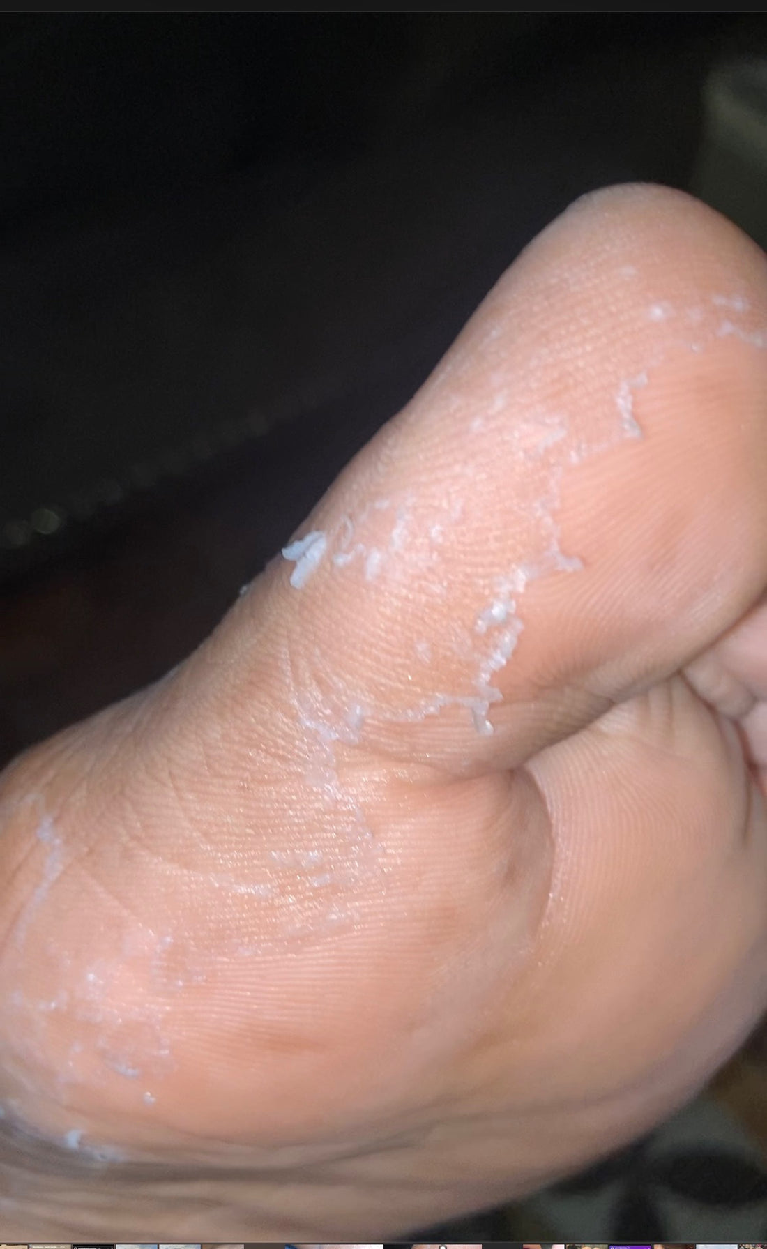Foot Peels